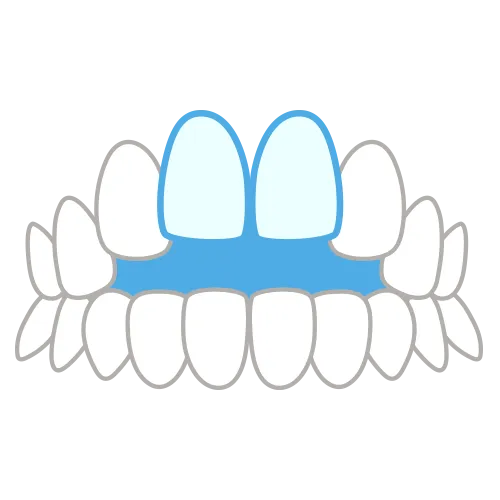 前歯が閉じない